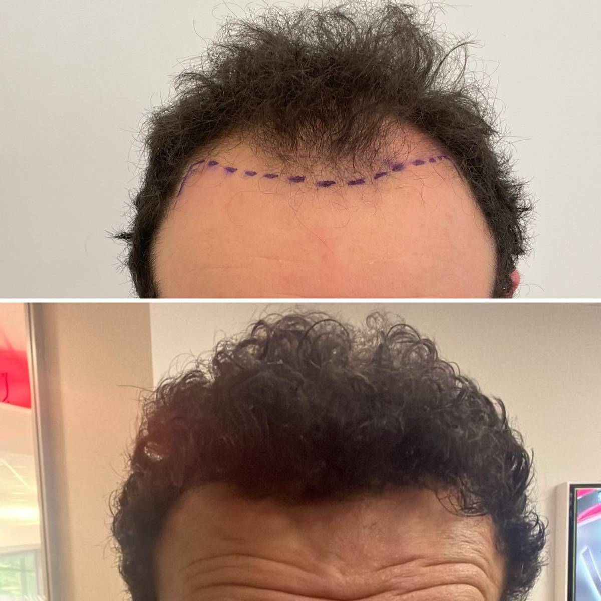 Spécialiste pour réalisation de micropigmentation du cuir chevelu, tatouage effet cheveux, pour masquer une calvitie vers Vitrolles proche de Martigues