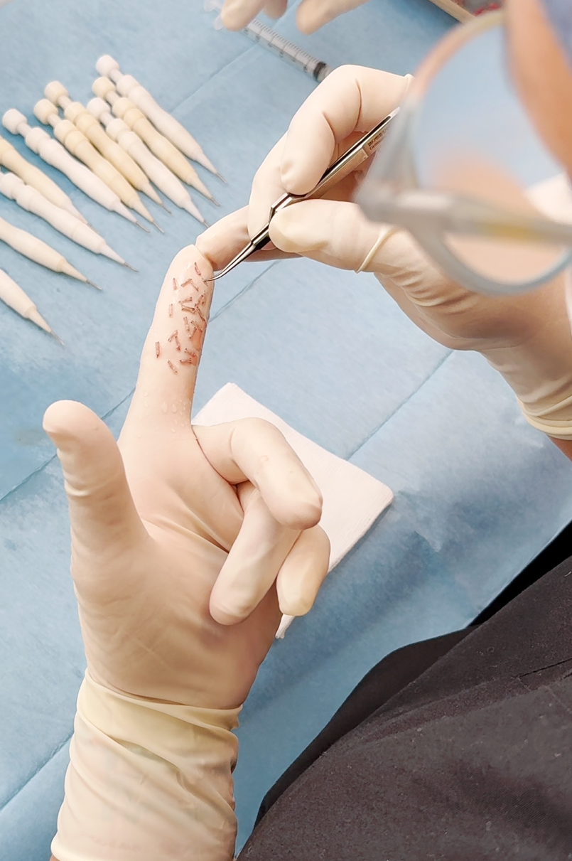 Greffons prélevés sur la zone donneuse pour une greffe capillaire à Marseille proche de Aubagne