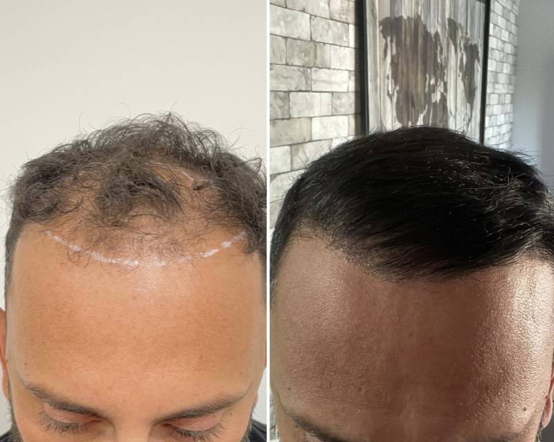 Reprise de Greffe faite à l'étranger 2300 greffons