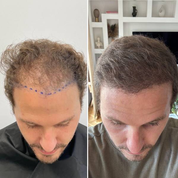 Greffe capillaire DHI à Marseille sans cicatrice pour hommes