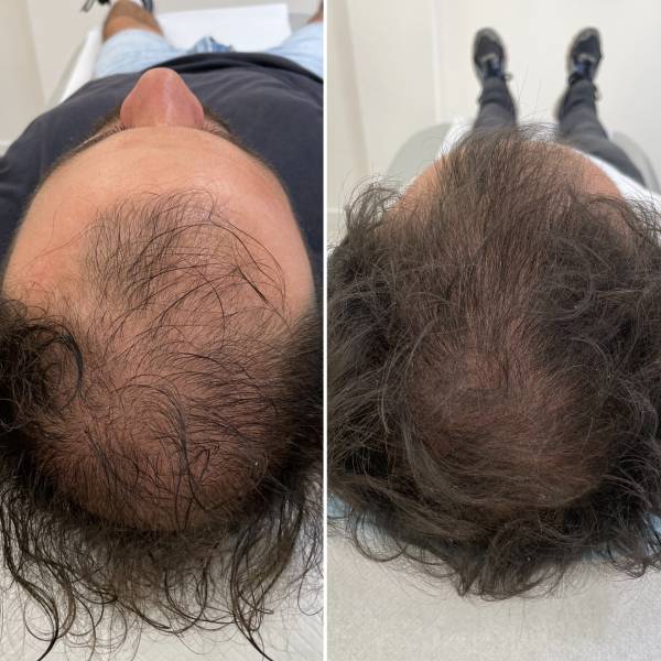 Le Traitement par Cellule Souche sur Marseille dans le cadre de l'alopécie androgénique