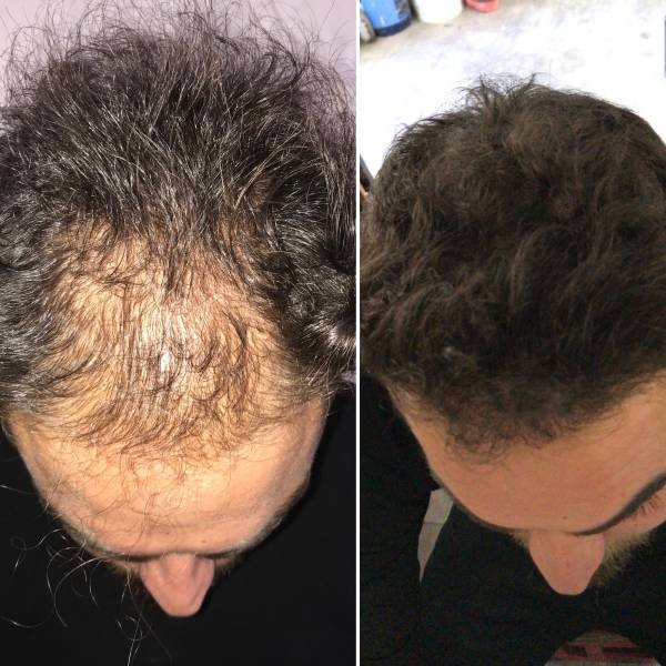 Greffe Capillaire ligne antérieure 2500 Greffons