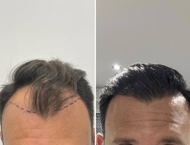 Greffe Capillaire ligne antérieure 2600 Greffons