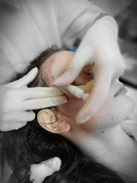 Mésogreffe capillaire à Marseille pour relancer la repousse avec cellules souches