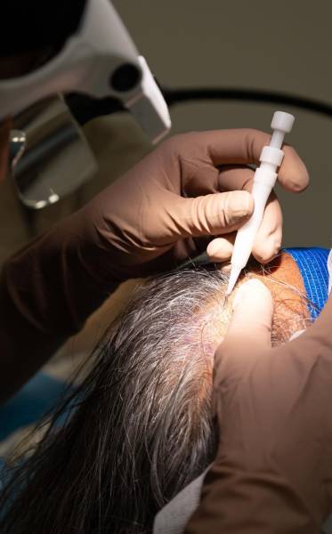 Greffe de cheveux FUE à Aix-en-Provence pour résultat naturel sans cicatrice