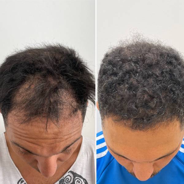 Greffe capillaire ligne frontale et tonsure 2500 Greffons