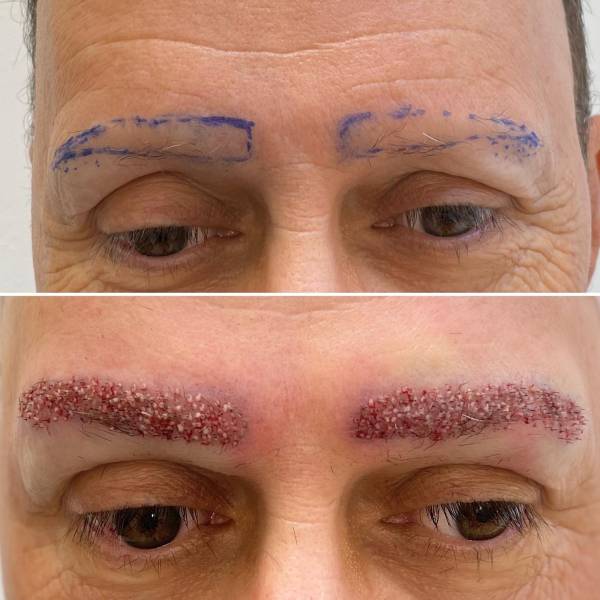 Greffe de sourcils à Marseille pour densifier une ligne clairsemée