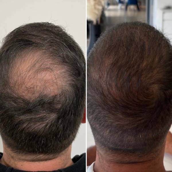 Greffe de La Tonsure ( 6mois post Greffe) 2300 Greffons 