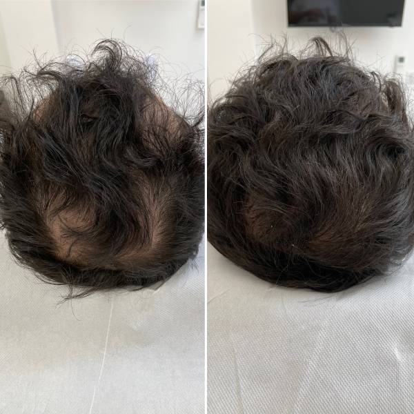 Traitement PRP/PRF associé à de la Led capillaire chez un patient âgée de 20 ans 