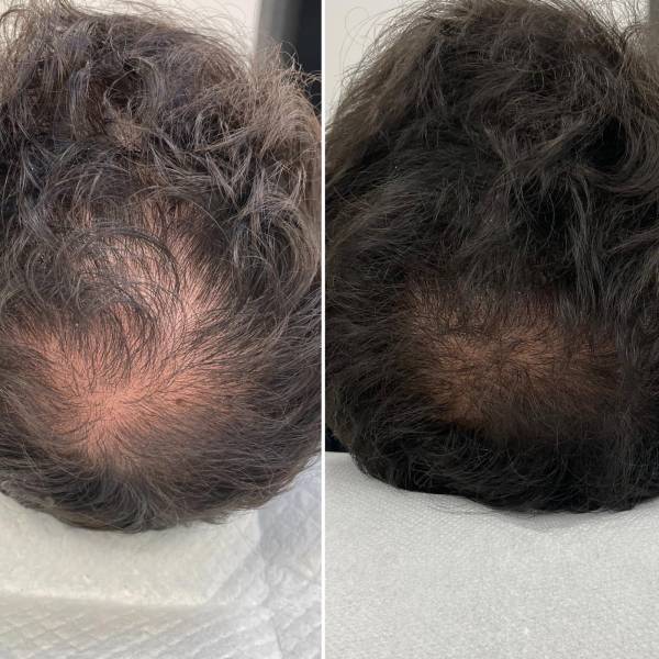 Mésogreffe capillaire à Aix-en-Provence avec cellules souches autologues