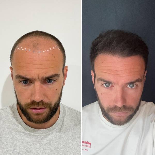 Greffe de cheveux en Turquie ou en France : que faut-il vraiment privilégier ?