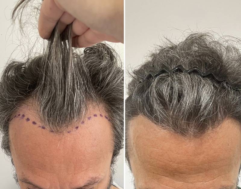 Greffe Capillaire ligne frontale 2100 Greffons