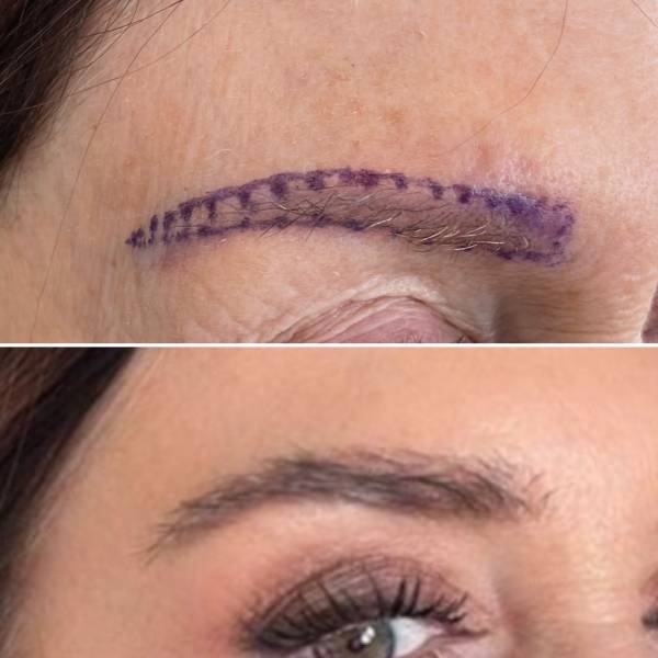 Greffe de sourcils 700 Greffons