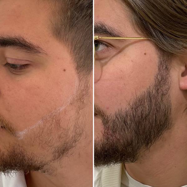 Greffe de Barbe 2800 Greffons