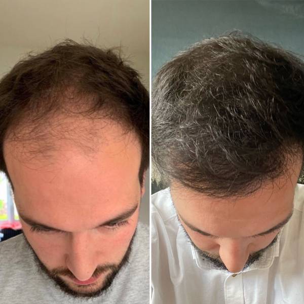 Greffe Capillaire ligne frontale 2800 Greffons 