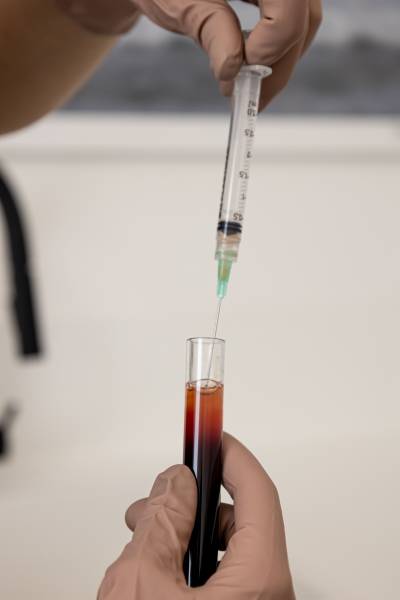 Traitement capillaire personnalisé combinant PRF/ PRP et mésothérapie pour une repousse optimale à Marseille et Aix-en-Provence