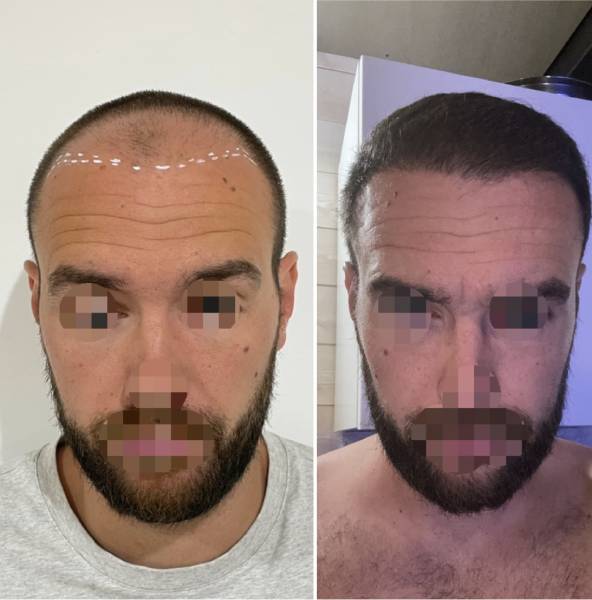 5 mois Post Greffe de 2650 Greffons