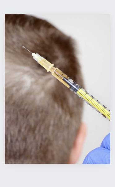 Traitement capillaire régénératif avec cellules souches pour lutter contre l'alopécie à Marseille, Nice et dans les Alpes-Maritimes
