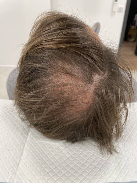 J'ai 20 ans et je commence à perdre mes cheveux, que dois-je faire?