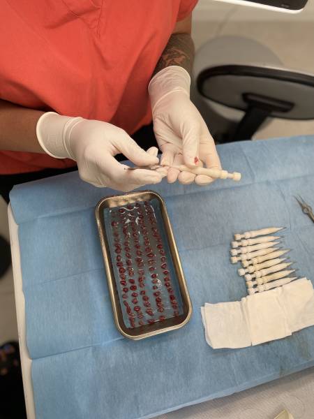 Le centre EREVCAPILLAIRE est fier de vous proposer la technique de réimplantation par FUE/Stylo CHOI