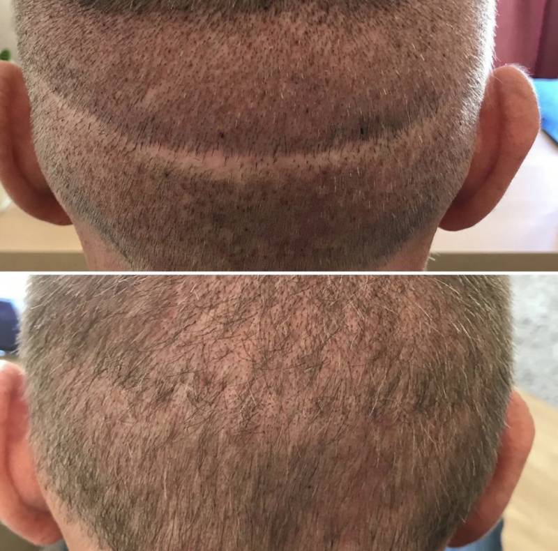 À qui s’adresse les séances de tricopigmentation ?