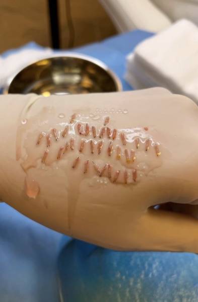 Greffe capillaire pour corriger une calvitie avancée chez l’homme à Marseille 13008 – Technique FUE pour un résultat naturel et durable