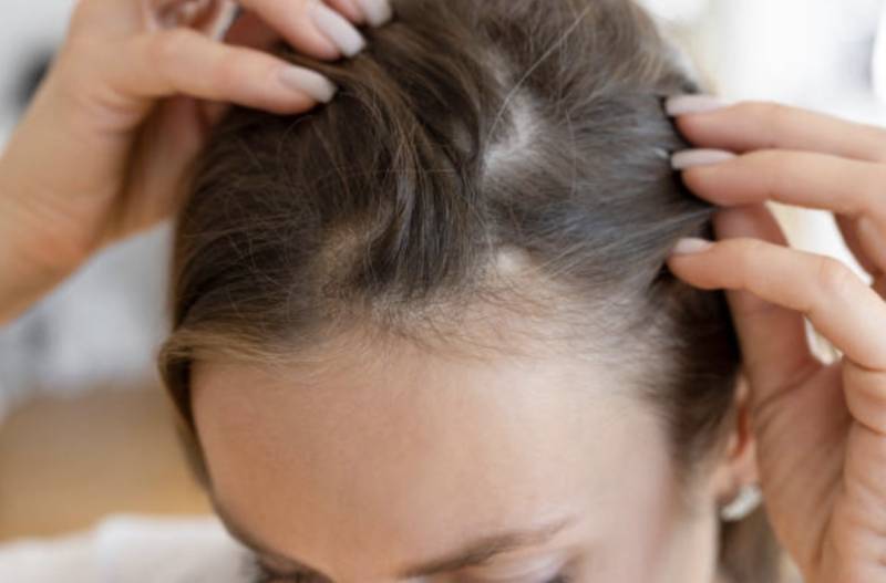 Chute de cheveux : l’analyse du cuir chevelu permet d’identifier la cause et d’adapter le traitement.