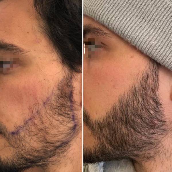 Greffe de Barbe 2500 Greffons