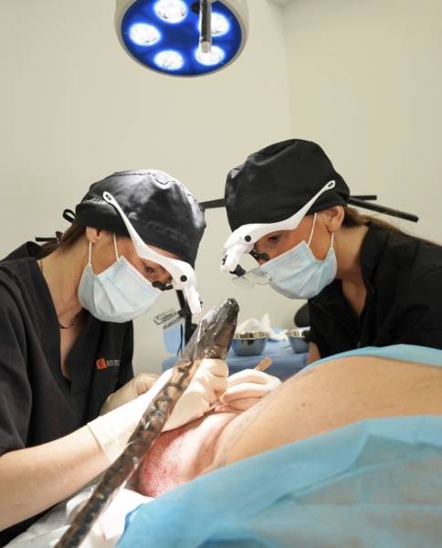 Greffe capillaire des golfes à Marseille 13009 pour corriger une calvitie débutante et retrouver une ligne frontale naturelle