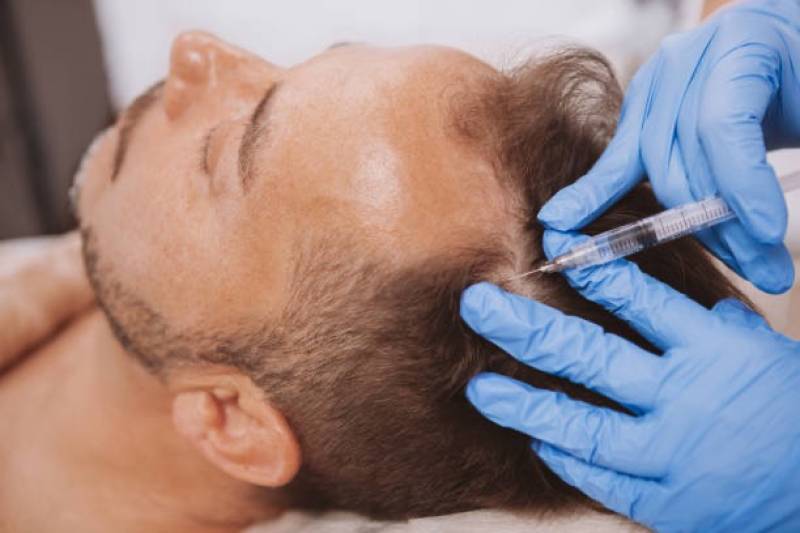 PRF capillaire en post-greffe pour optimiser la prise des greffons