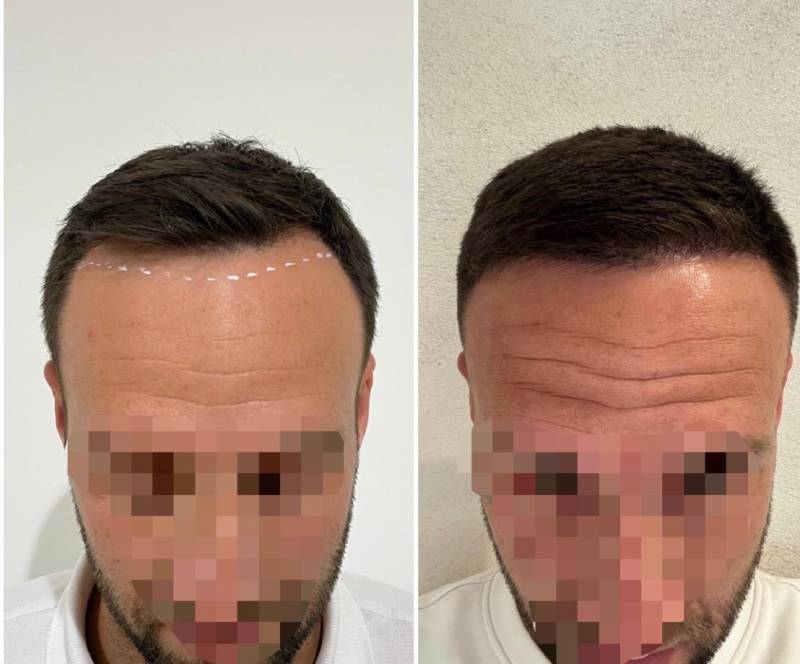 Comment corriger des golfes temporaux dégarnis chez un homme de 30 ans à Aubagne ?