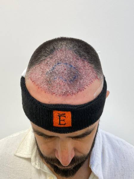 Greffe capillaire homme à Aubagne pour densité frontale naturelle