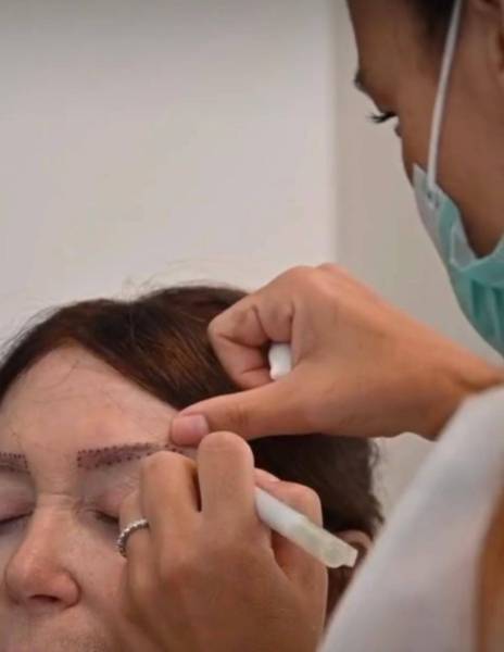 Greffe de sourcils : La solution naturelle qui transforme votre regard