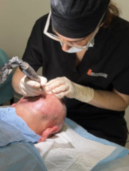 Greffe capillaire : quand la solution devient un projet sur-mesure