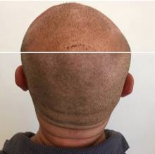 Notre zone d'activité pour ce service Spécialiste pour réalisation de micropigmentation du cuir chevelu, tatouage effet cheveux, pour masquer une calvitie