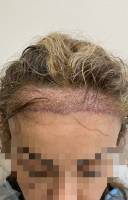 Notre zone d'activité pour ce service Réaliser une greffe de cheveux avec résultats sans cicatrices pour restaurer votre densité capillaire